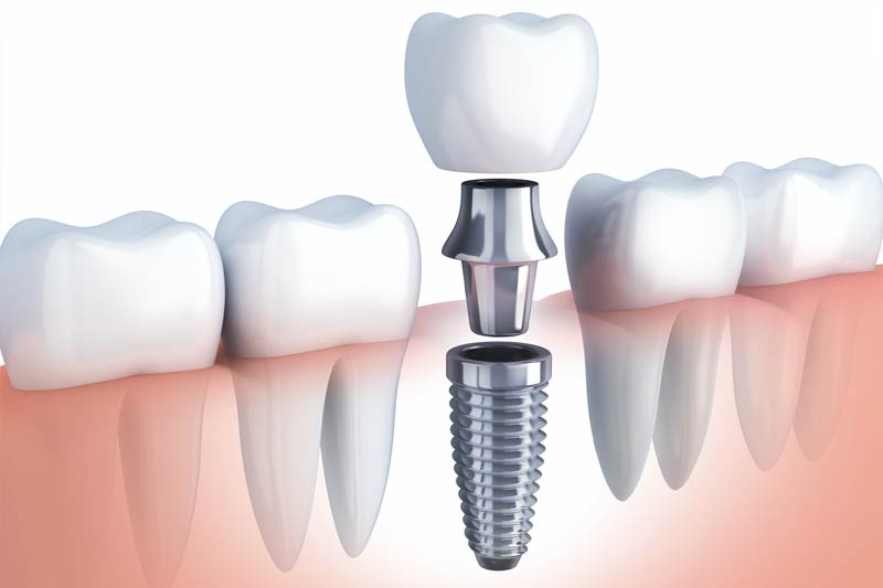 Implants Dentist in Aubrey
